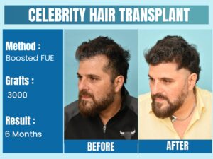 Celebrity Hair Transplant Before After Results