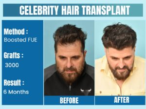 Celebrity Hair Transplant Before After Results