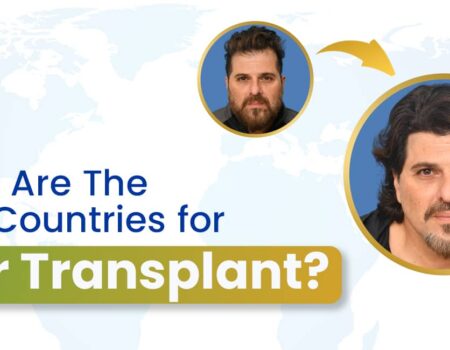 What are the Best Countries for Hair Transplant Surgery