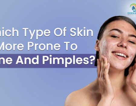 Which Type of Skin is More Prone to Acne and Pimples