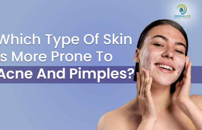 Which Type of Skin is More Prone to Acne and Pimples