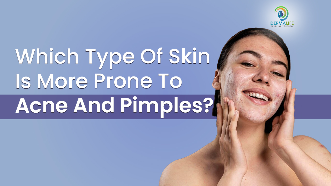 Which Type of Skin is More Prone to Acne and Pimples