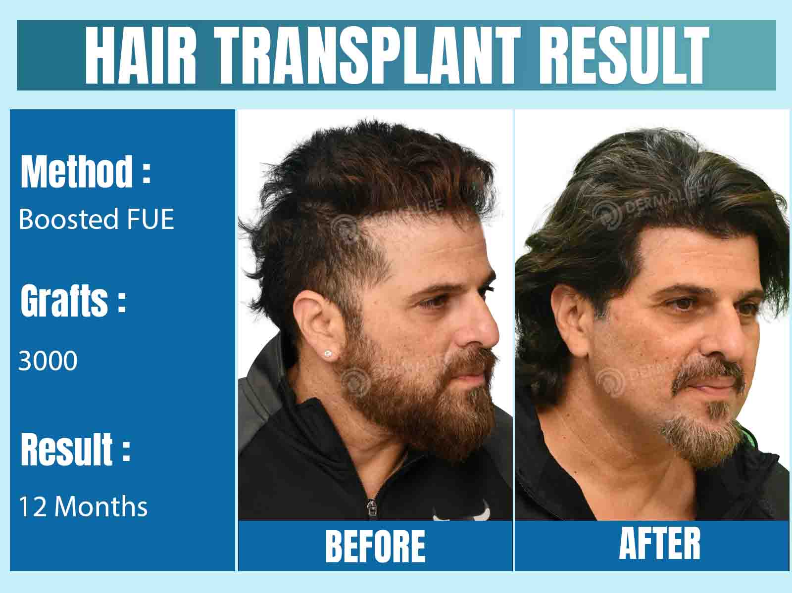 celebrity hair transplant doctor in India
