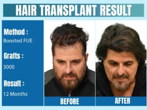 celebrity hair transplant in Delhi