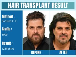 celebrity hair transplant in India