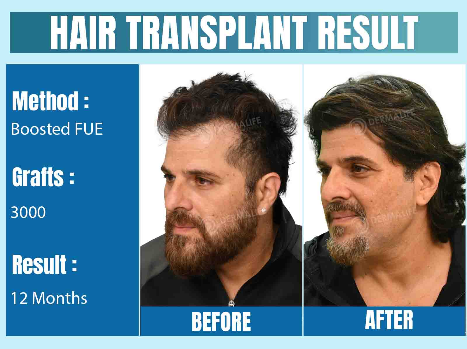celebrity hair transplant in Mumbai