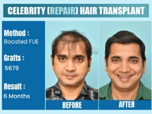 Celebrity Before & After Hair Transplant