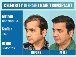 Result of Celebrity Before After Hair Transplant