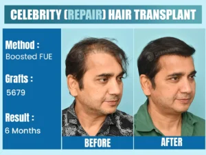 Result of Celebrity Before After Hair Transplant