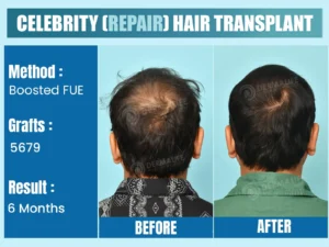 Result of Celebrity Before After Hair Transplant