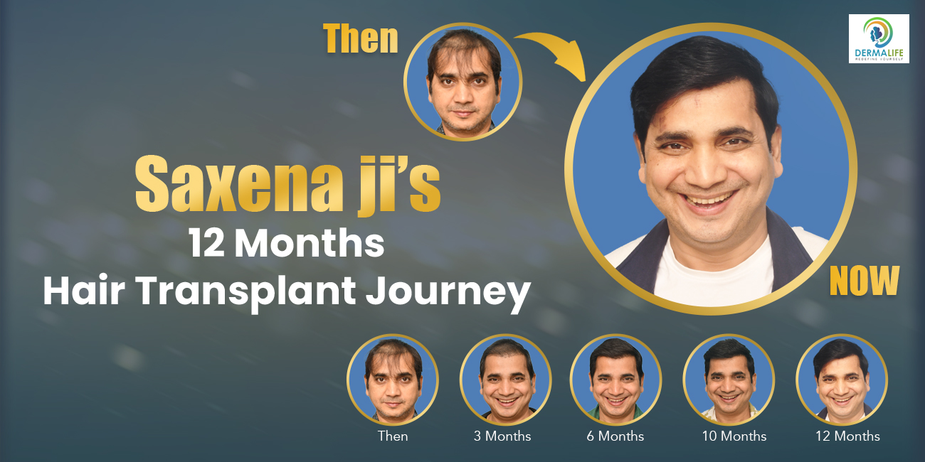 The Transformation of Sanand Saxena A Hair Transplant Journey with Dermalife