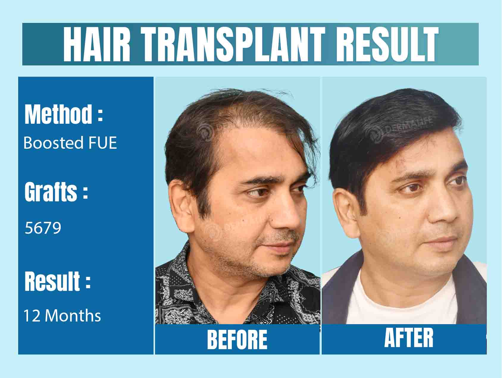 celebrity hair transplant Surgeon in Chennai