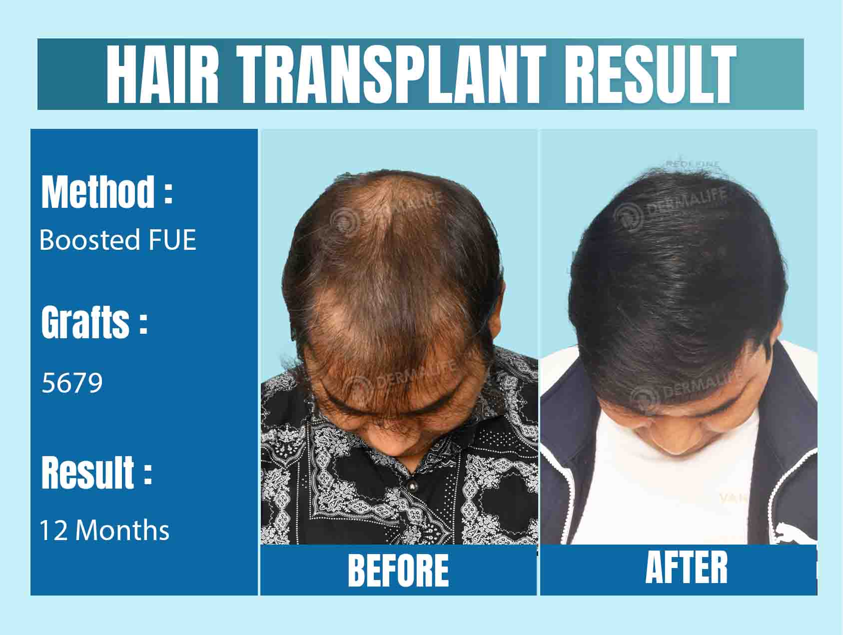 celebrity hair transplant Surgeon in Delhi