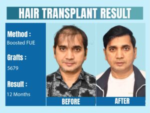 celebrity hair transplant Surgeon in India