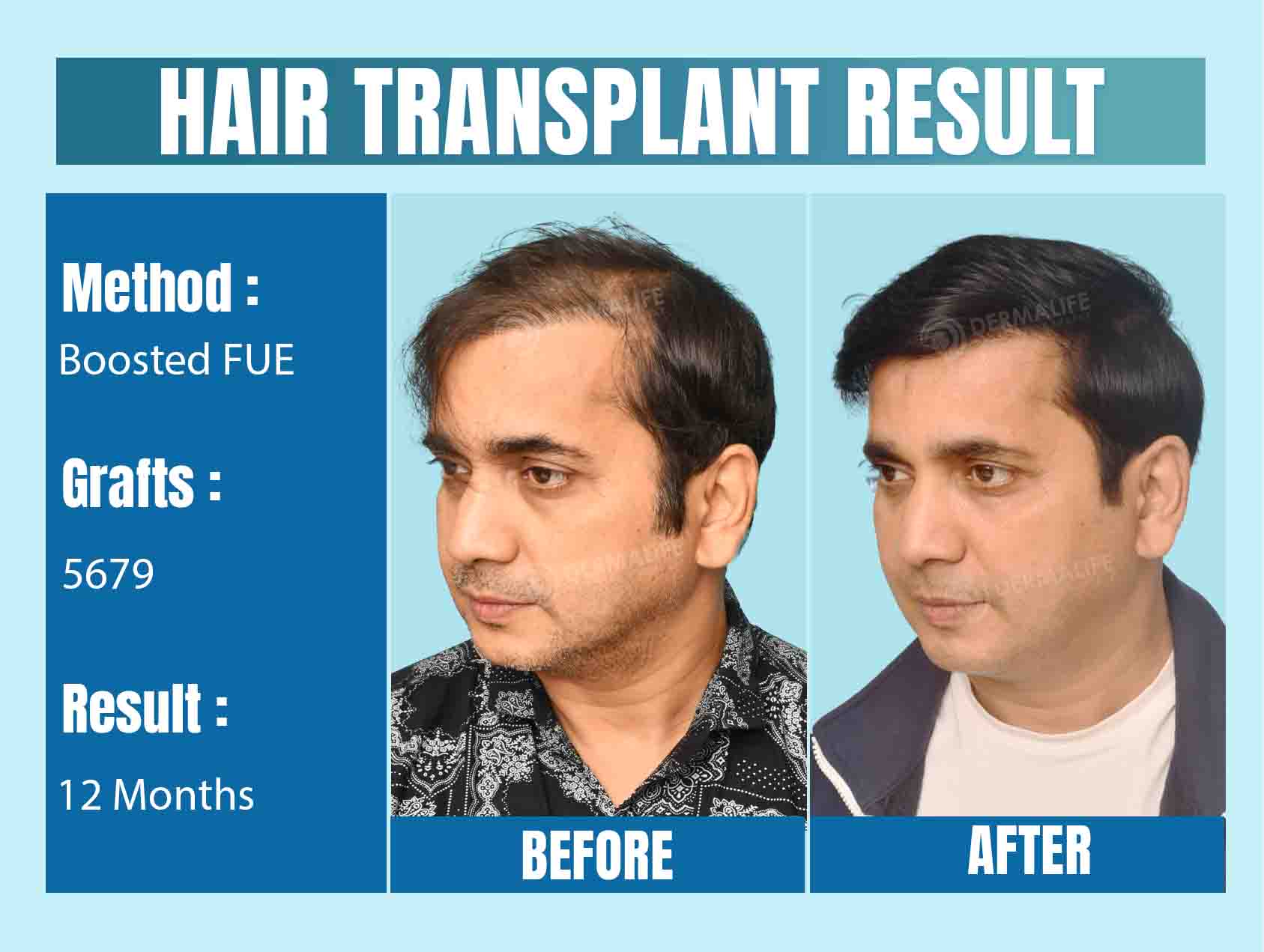 celebrity hair transplant Surgeon in Mumbai