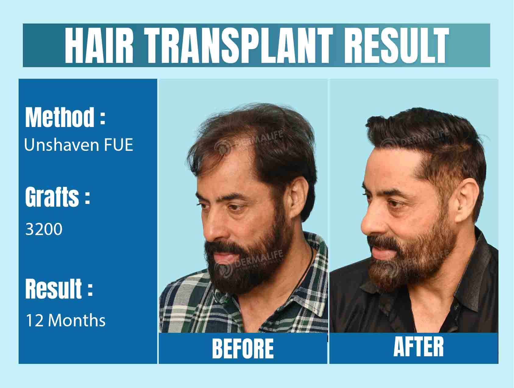 Long hair transplant in Delhi