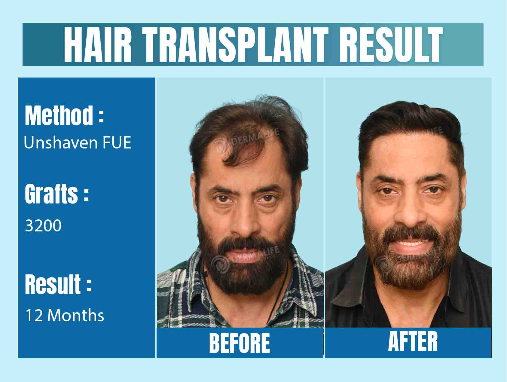 Long hair transplant in Delhi