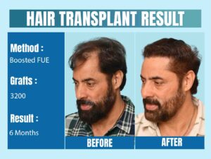 celebrity hair transplant before and after