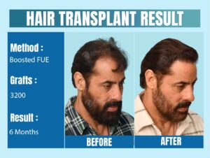 celebrity hair transplant before and after