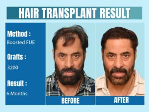 celebrity hair transplant before and after