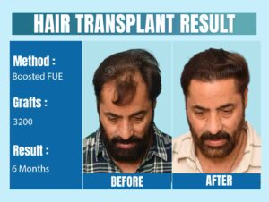 celebrity hair transplant before and after