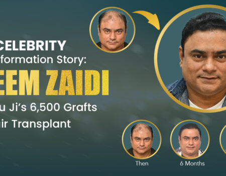 Saleem Zaidi’s 6,500 Graft Hair Transplant Journey with Dr. Gaurav Garg at Dermalife