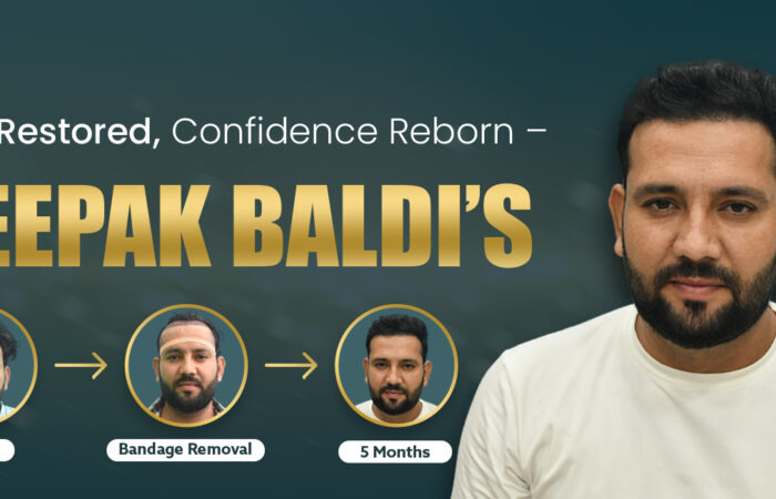 Unshaven FUE Hair Transplant