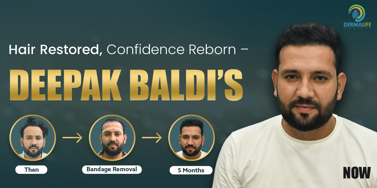 Unshaven FUE Hair Transplant