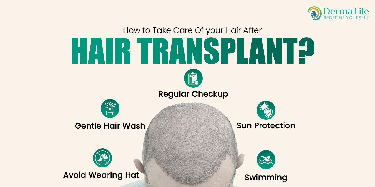 How to Take Care of Your Hair After a Hair Transplant