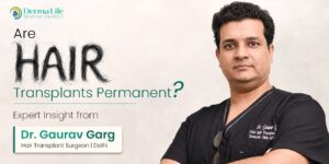Are Hair Transplants Permanent? Expert Insight from Dr. Gaurav Garg in Delhi