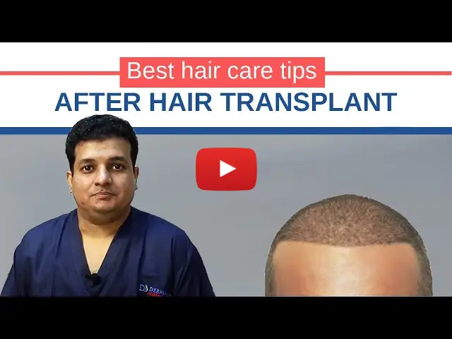 best hair transplant in Delhi
