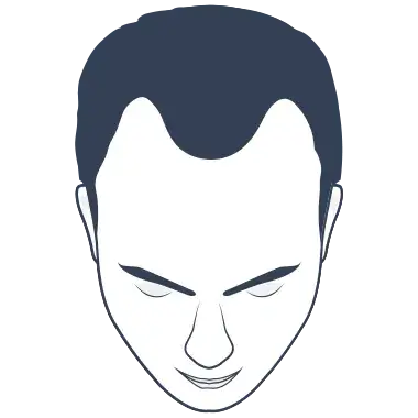 Hair Loss Type 2