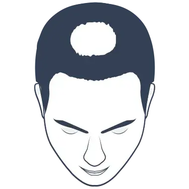 Hair Loss Type 3