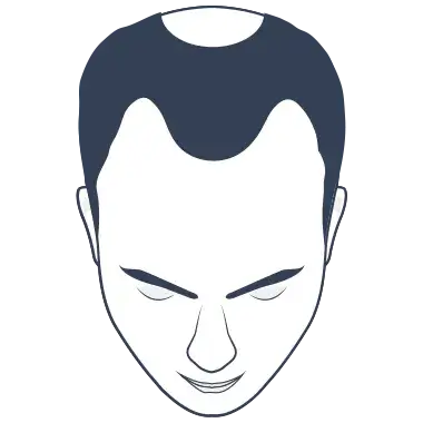 Hair Loss Type 4