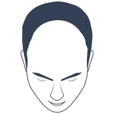 Hair Loss Type 5