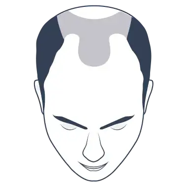 Hair Loss Type 6