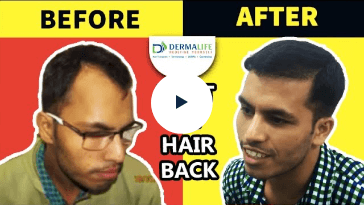 Dermalife hair transplant testimonials