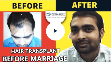 Dermalife hair transplant testimonials