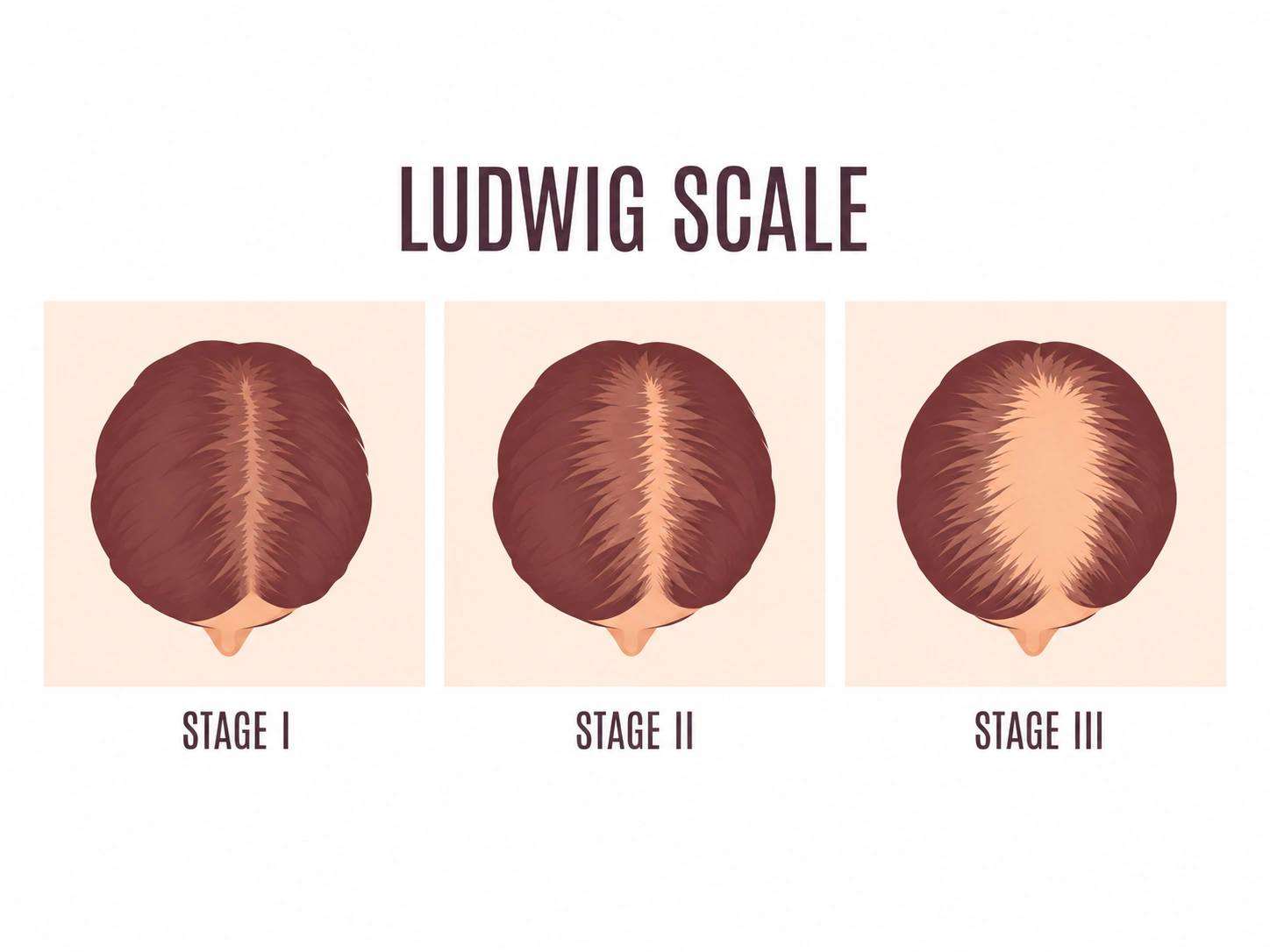Female Hair Transplant Cost in Delhi