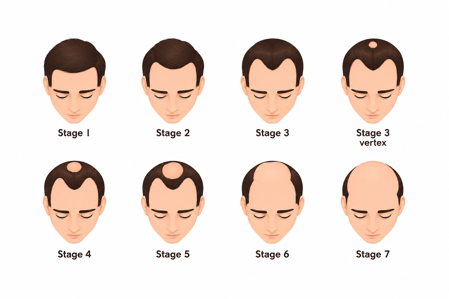 Hair Transplant Cost by Hair-Loss Stage