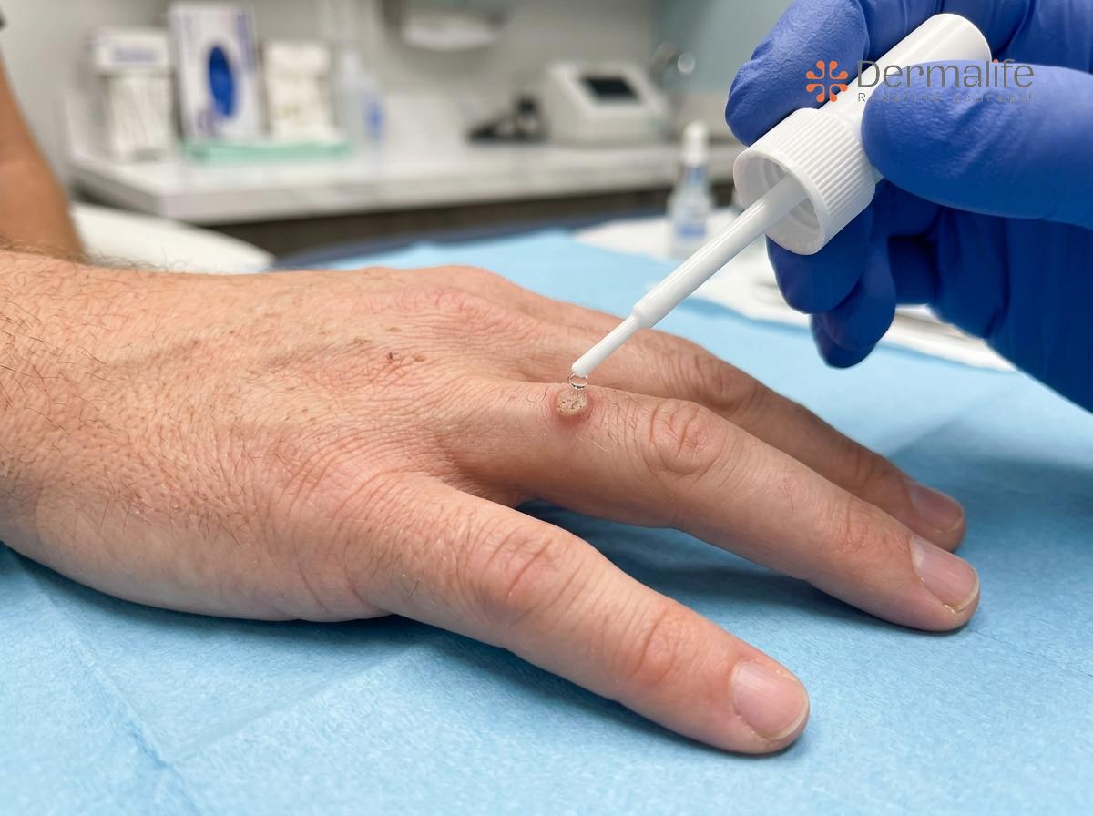 Salicylic Acid Peeling