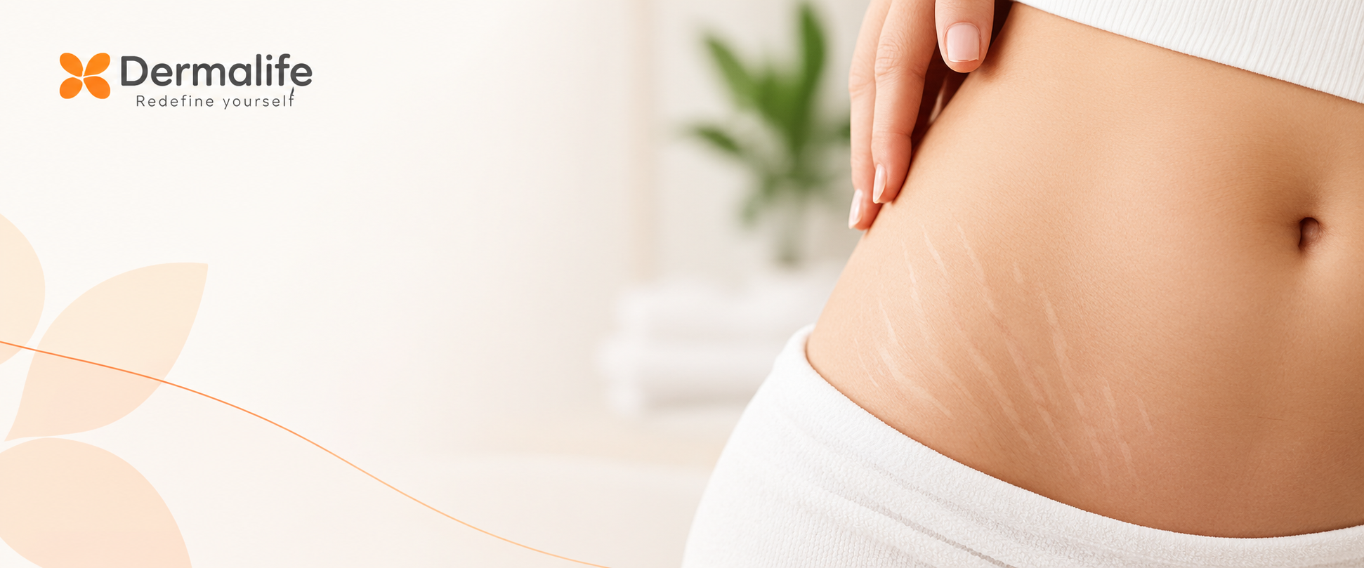 Don't Let Stretch Mark-play with your Joy