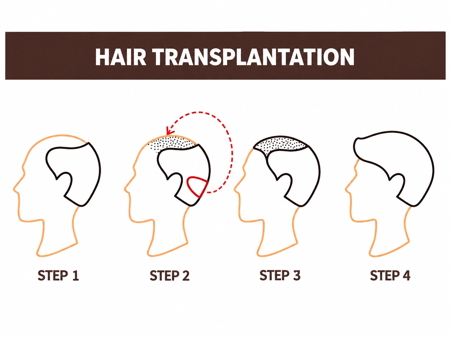 How the Surgical Technique Changes the Cost