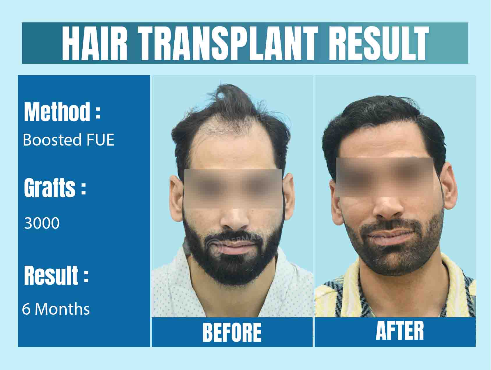 3000 grafts hair transplant cost in India