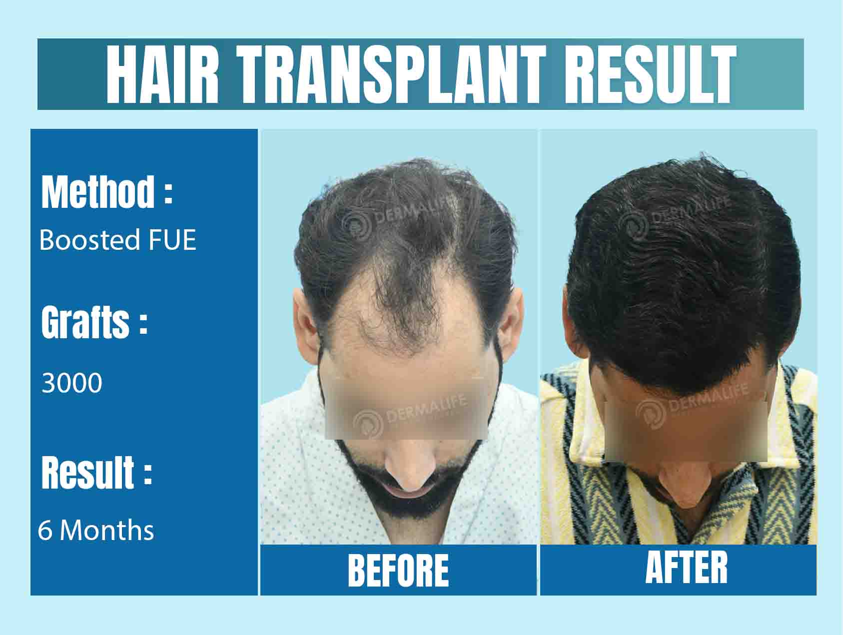 3000 grafts hair transplant cost in India