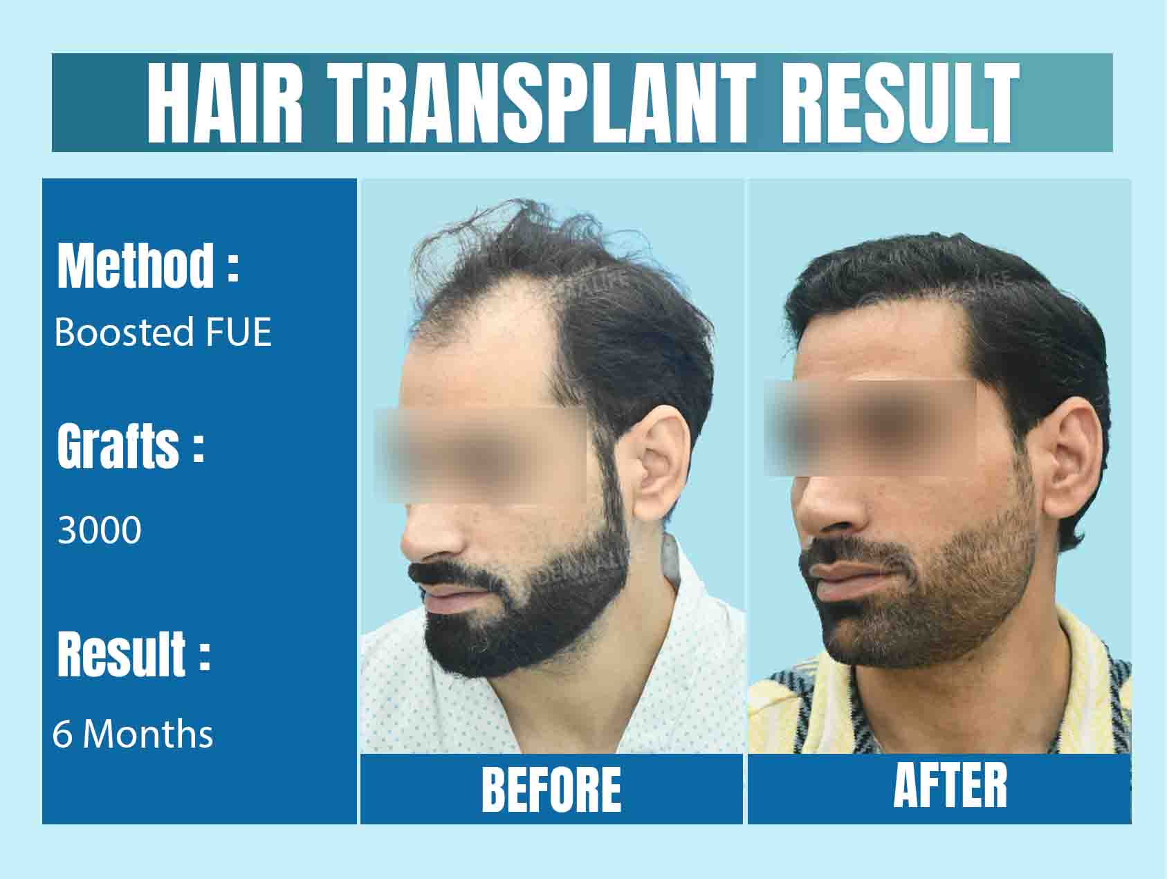 3000 grafts hair transplant cost in India