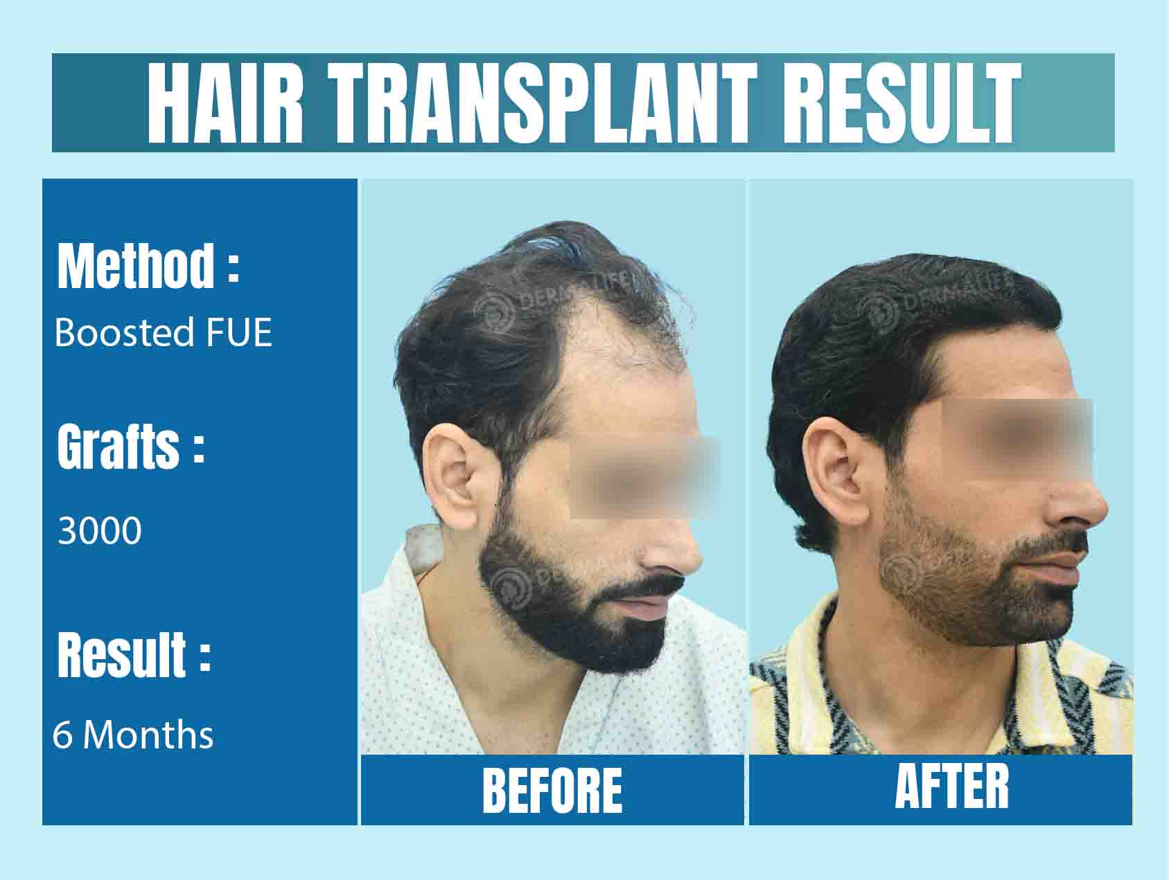 3000 grafts hair transplant cost in India