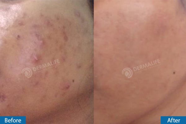 Acne_Skin_Treatment_Before_After