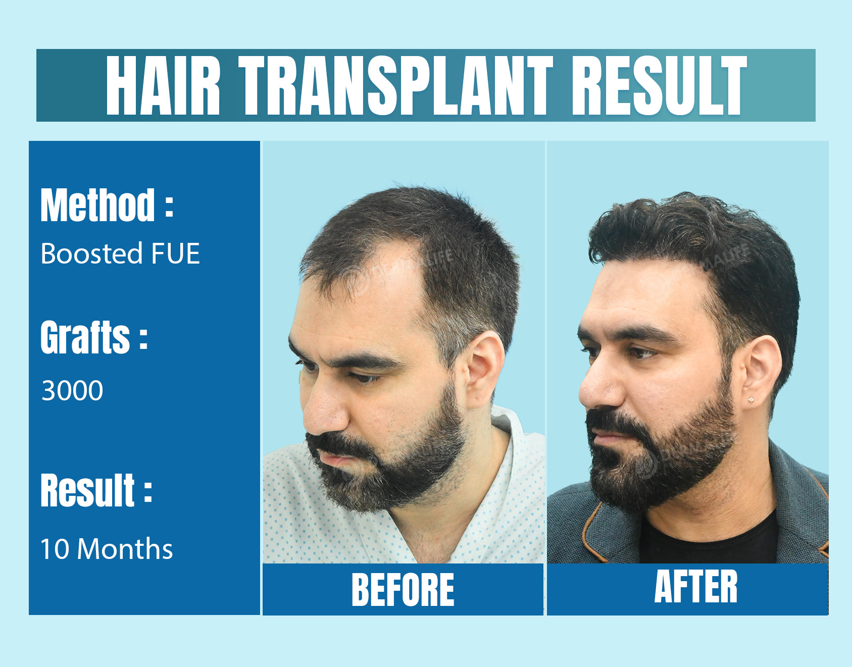 Affordable Best Hair Transplant clinic in Delhi