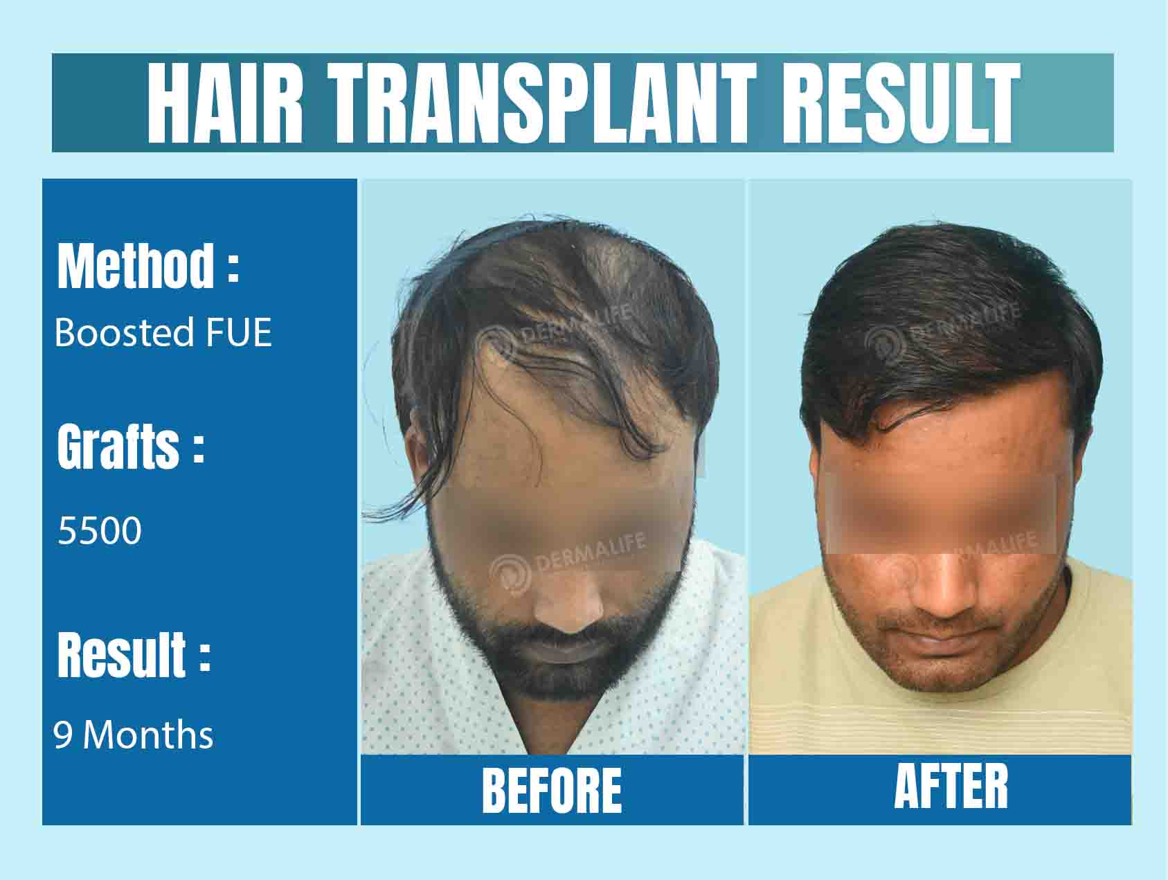 Hair Transplant Before After Result in Delhi